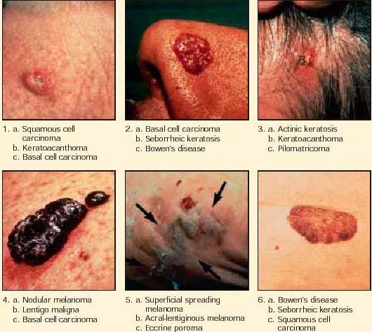 Skin-Cancer