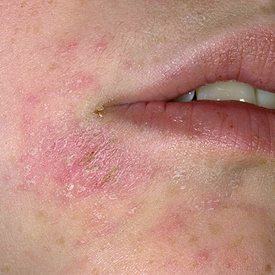 eczema