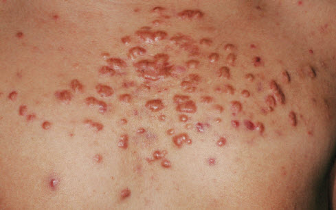 keloids