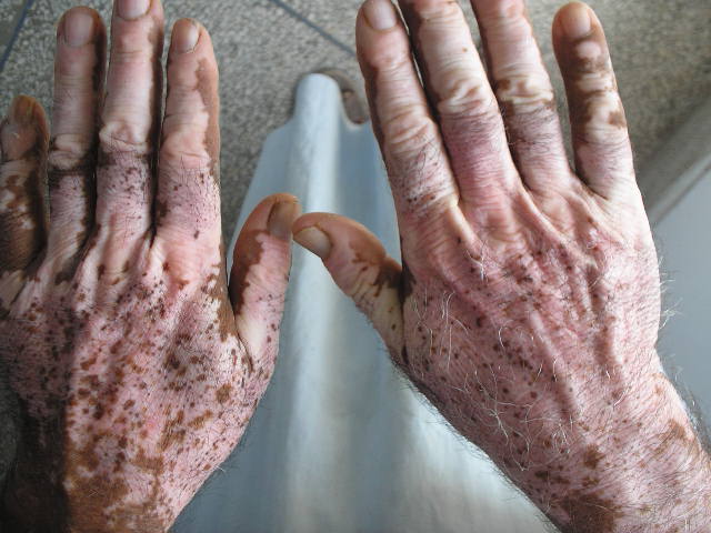 vitiligo